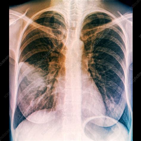 Lungs In Pneumonia X Ray Stock Image C0299955 Science Photo Library