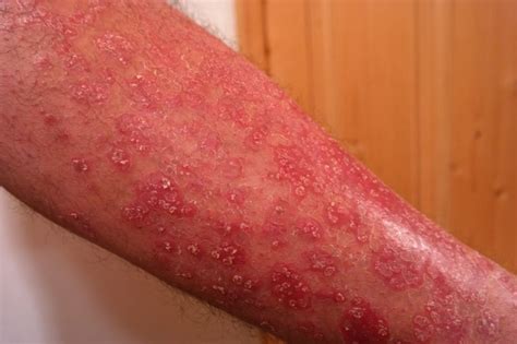 Dermatitis Herpetiforme Qu Es Diagn Stico Tratamiento S Ntomas