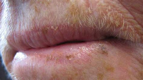How To Treat Actinic Keratosis On Lips
