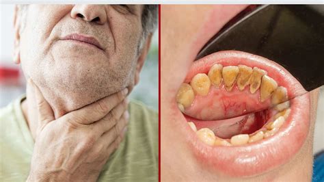 Oral Cancer Pictures