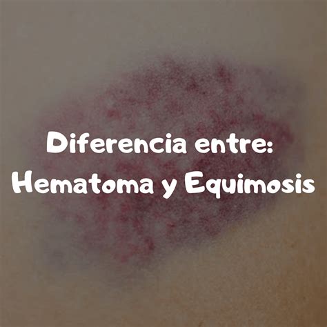 Hematoma Y Equimosis Diferencia