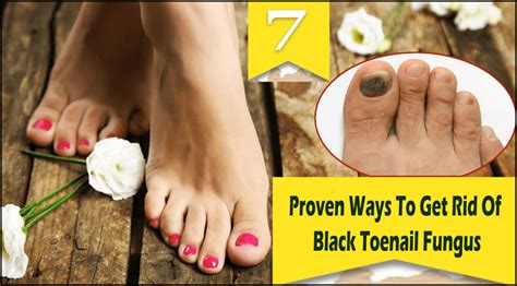 7 Proven Ways To Get Rid Of Black Toenail Fungus Black Toenail Fungus