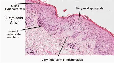 Dermatopathology Made Simple Inflammatory Psoriasiform Reaction Pattern