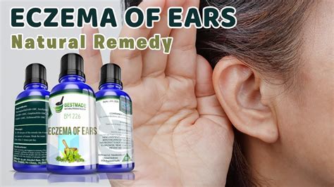 Eczema Of Ears Natural Remedy Bm 226 Youtube