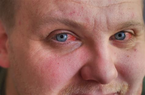 How To Help Bloodshot Eyes Soupcrazy1