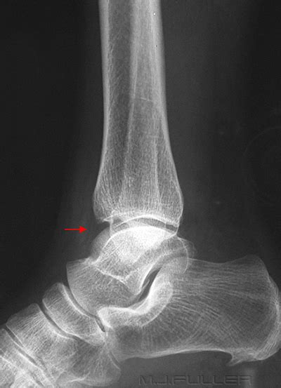 Soft Tissue Signs The Ankle Wikiradiography