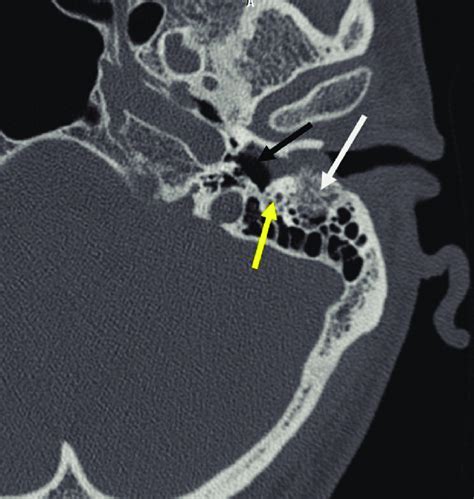 Hrct Temporal Bone Of Left Side Showing Soft Tissue Mass In Left Eac