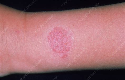 Contact Dermatitis Wristwatch Allergy Stock Image M3200174