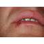 Cold Sore Photograph By Cnri/science Photo Library