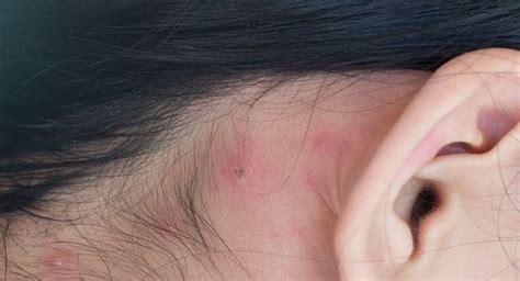 here s how you can treat pimples behind the ears