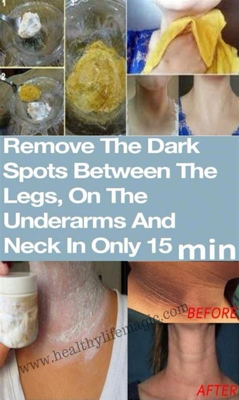 Ways To Get Rid Of Darkish Spots On Deal With Right Away