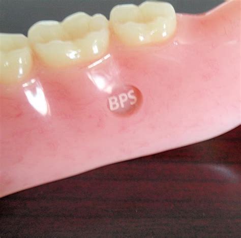 bps dentures in kanyakumari by edens dental and maxillofacial hospital id 10087275791