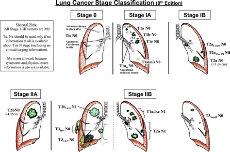 The Eighth Edition Lung Cancer Stage Classification Chest