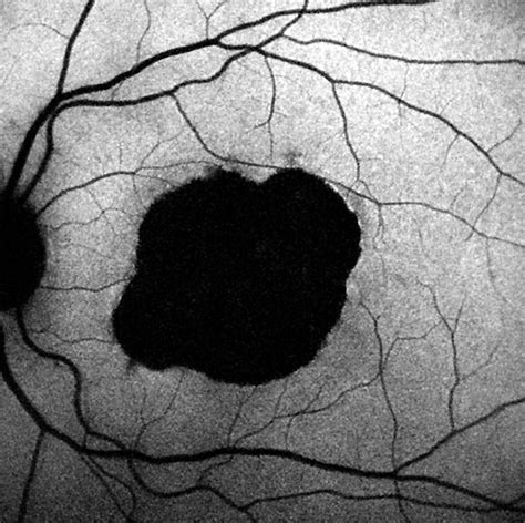 Classification Of Abnormal Fundus Autofluorescence Patterns In The