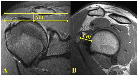 Jcm Free Full Text Coracoid Impingement And Morphology Is