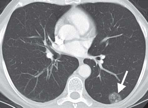 Solitary And Multiple Pulmonary Nodules Radiology Key