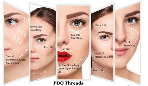 PDO Thread Lift And How To Choose The Right One