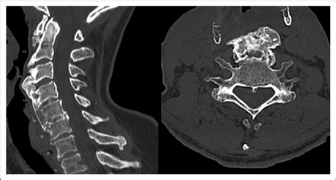 Patient 1 Computed Tomography Ct Cervical Spine Sagittal Left And