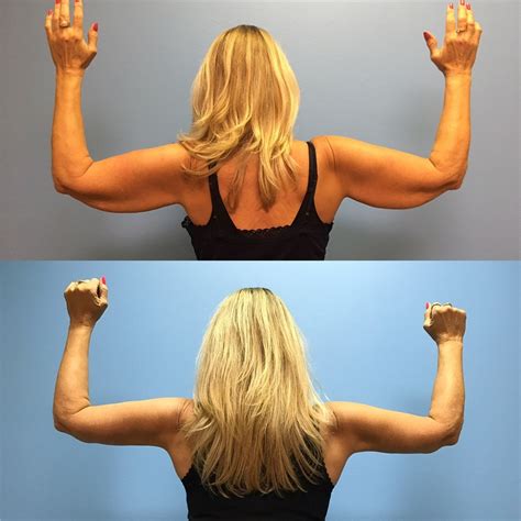 Arm Lift Before And After Photos By Jason Petrungaro Md Facs Munster