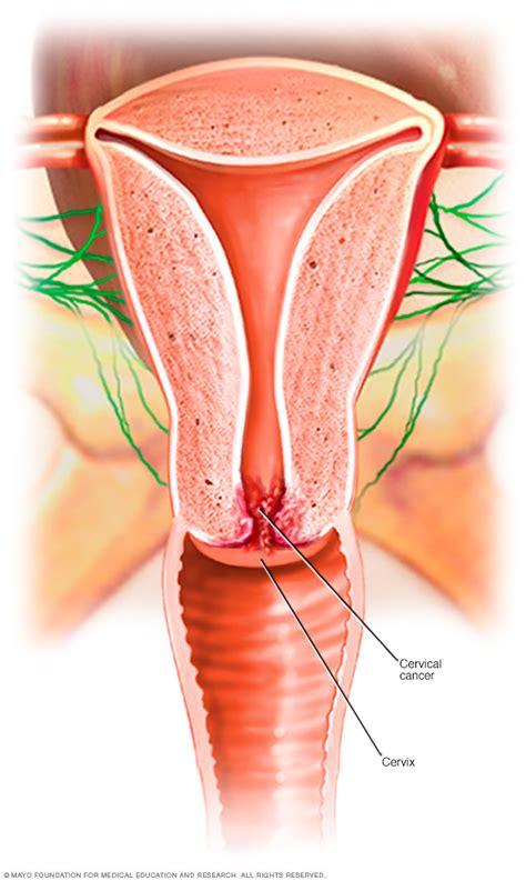 Cervical Cancer Disease Reference Guide