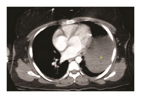 Postcontrast Intravenous Axial Ct Image Confirms A Fluid Filled