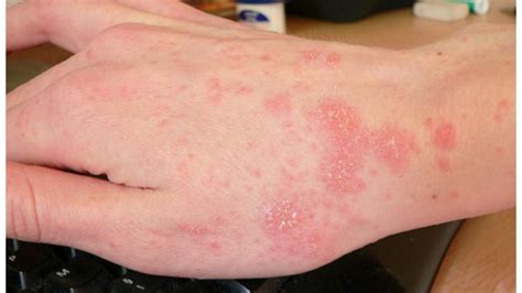How To Differentiate Scabies From Bed Bug Bites Pest Phobia