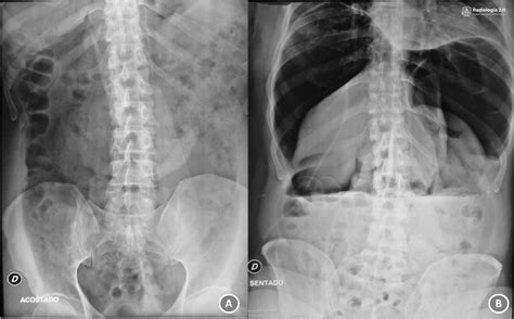 Radiografía De Abdomen Ap Neumoperitoneo A Paciente En Decúbito
