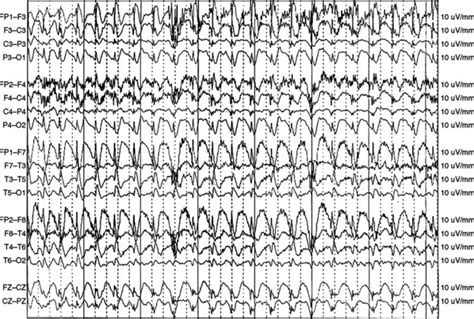 Management Of Status Epilepticus Clinical Gate