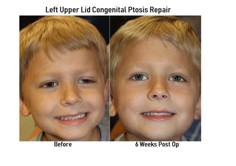 Maybe you would like to learn more about one of these? Eyelid Ptosis Treatment Austin | Drooping Eyelids | Dr. Amato
