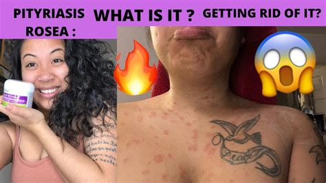 Pityriasis Rosea What It Is And Getting Rid Of It Youtube