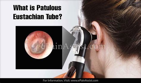 What Is Patulous Eustachian Tube Causes Symptoms Treatment
