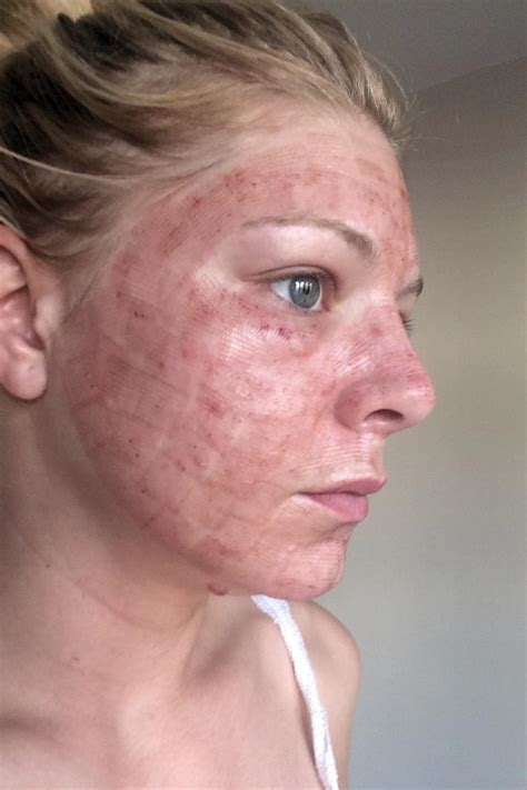 The thyroid hormone imbalance conditions such as known as hypothyroidism8 can cause. Facial laser to freshen my skin ruined my life after ...