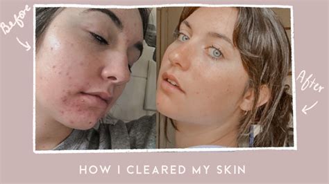 My Skincare Journey How I Finally Cleared My Acne Youtube