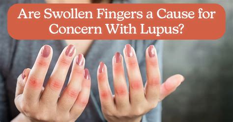 Are Swollen Fingers A Cause For Concern With Lupus Mylupusteam