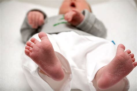 Durch die reibung von kleidungsstücken oder windeln führen kann. Baby trockene Haut: Ursachen, Symptome und Möglichkeiten ...