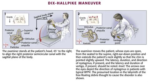 Vestibular Examination Dix Hallpike Maneuver For Bppv Epomedicine