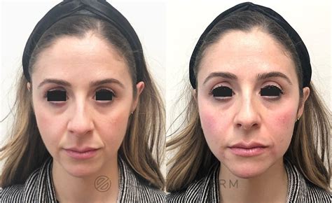 Dermal Fillers And Lip Injections Natick Wellesley And Weston Ma