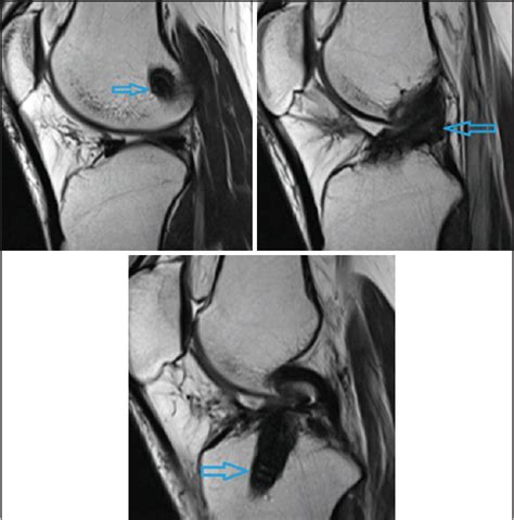 Magnetic Resonance Imaging Evaluation Of Cruciate Ligaments After