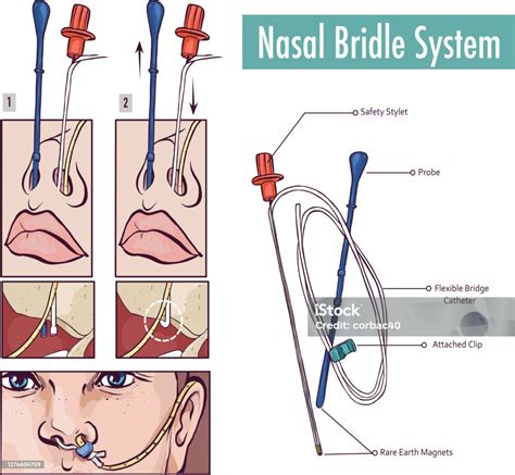 A Nasal Bridle Attaching A Nasogastric Tube To The Nasal Septum To