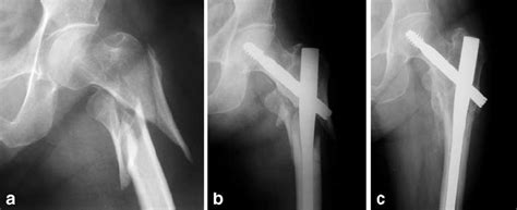 Reverse Oblique Trochanteric Fracture Treatment With A Long Gamma Nail