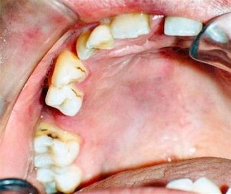 Capillary Hemangioma As A Rare Benign Tumor Of The Oral Cavity A Case