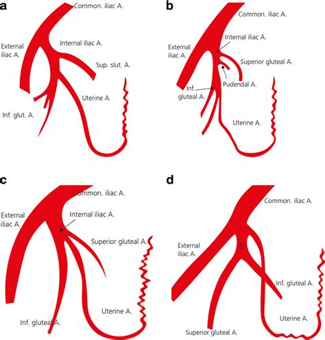 A D Anatomic Variations Of Normal Uterine Artery A Uterine Artery As