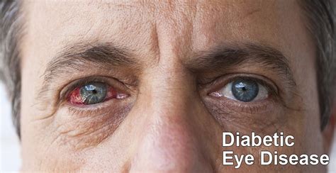 Treatments Available For Diabetic Eye Disease Depending Upon Its Types