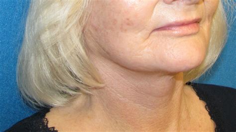 Faceliftneck Lift Rhytidectomy Before And After Gallery Awaken