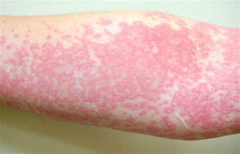 What Is A Chlorine Rash Experts Explain Why Your Skin Might Feel Itchy