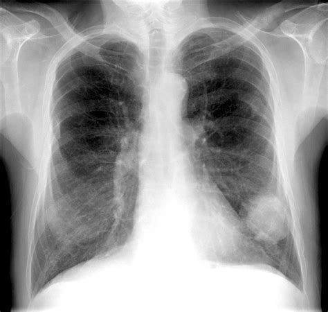 lung cancer x ray photograph by du cane medical imaging ltd