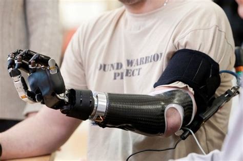 Black Carbon Fiber Above Elbow Prosthesis Arm Limb Size S L Nano