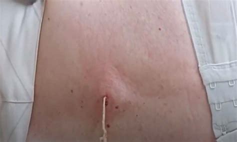 Draining Pus From Cyst On The Back New Pimple Popping Videos