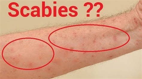 Narrowsdesigns How Do I Know If I Have Scabies Or Eczema