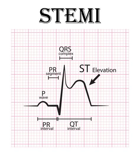 Maybe you would like to learn more about one of these? Acute Myocardial Infarction | NursingCE